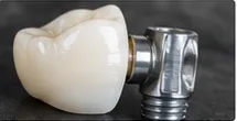 Review placeholder for Implant Restorations