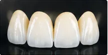 Review placeholder for Veneers